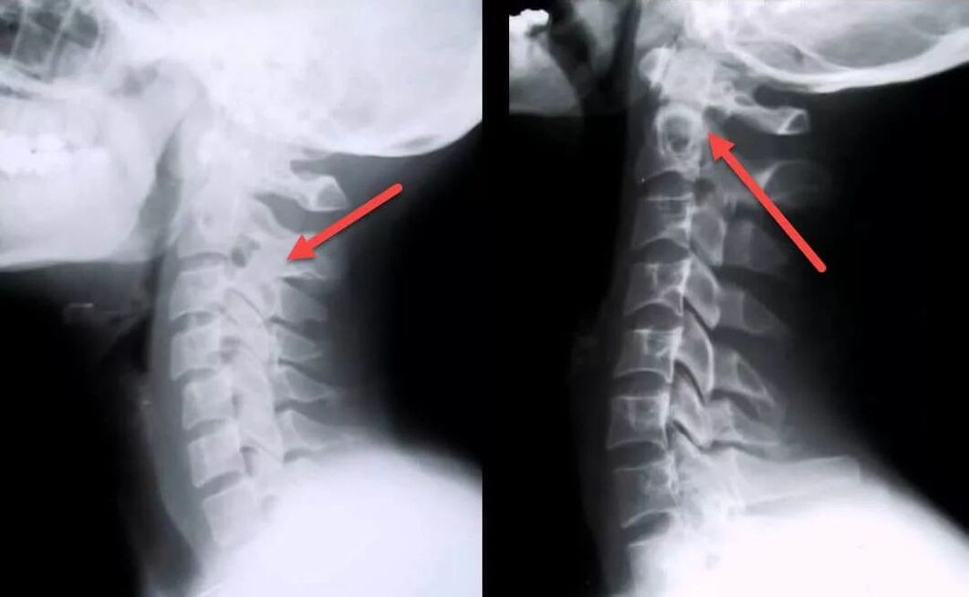 diagnose van cervicale osteochondrose