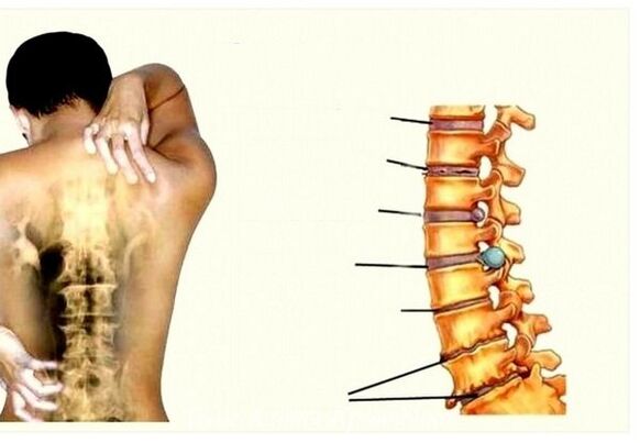 Fasen van cervicale osteochondrose