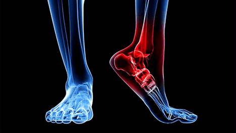 Arthrose van het enkelgewricht