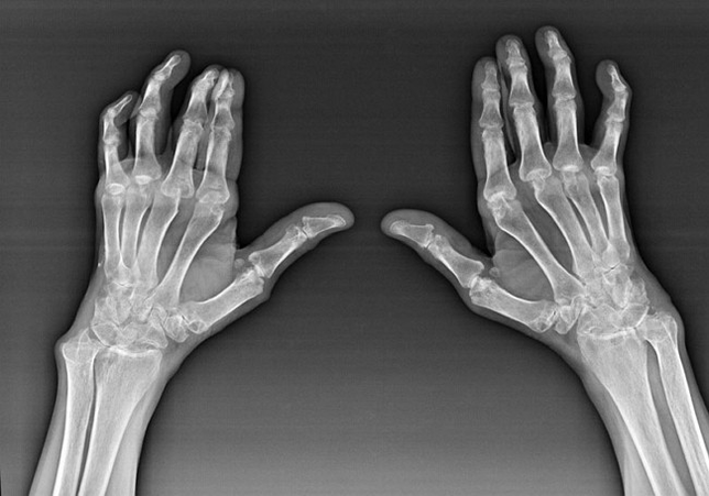 Diagnostiek van de gewrichten van de vingers