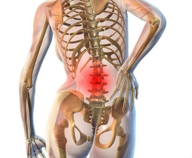 Osteochondrose van de lumbale wervelkolom