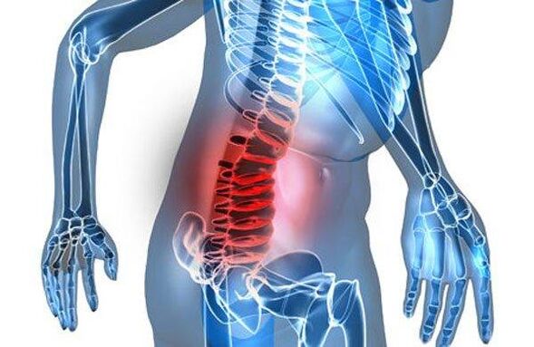 Vervorming van de wervelkolom in de vierde fase van lumbale osteochondrose