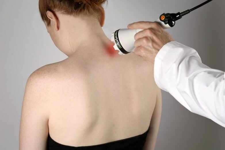 Laserbehandeling van cervicale osteochondrose bij vrouwen