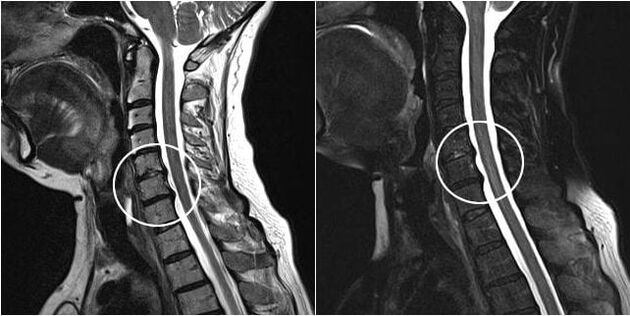 MRI van de cervicale wervelkolom met tekenen van osteochondrose