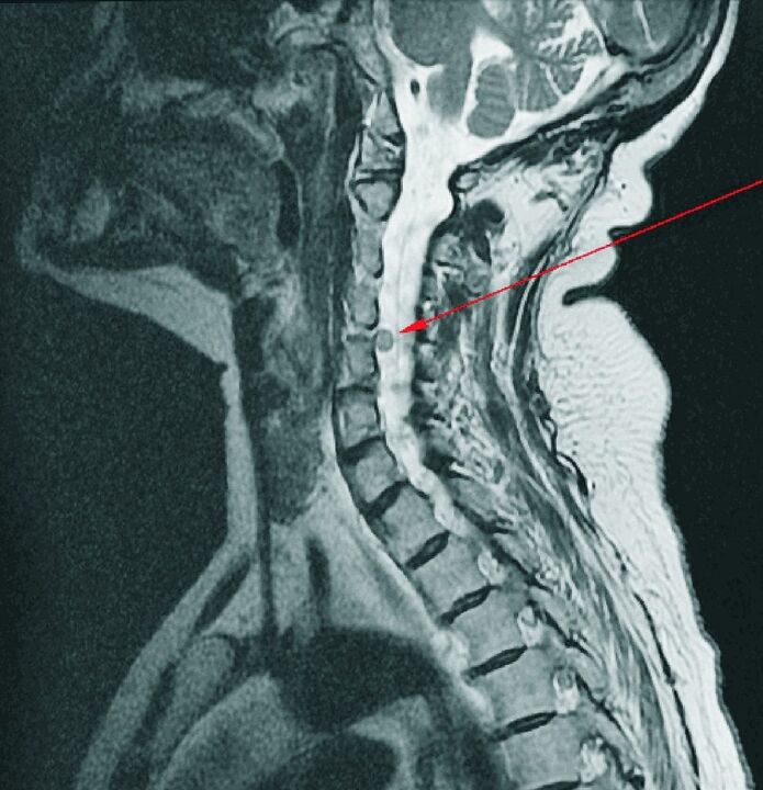 Tussenwervelhernia van de cervicale wervelkolom op MRI